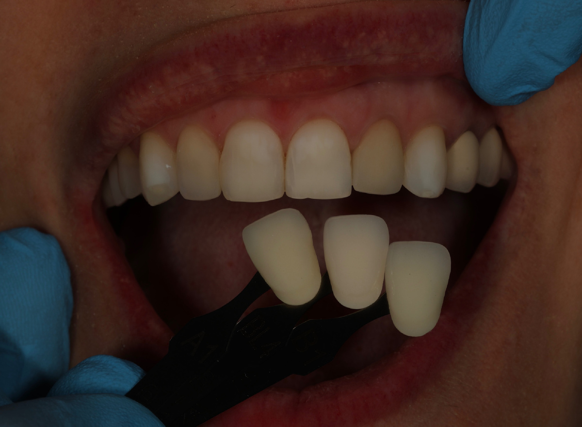 Поляризационный фильтр и подбор оттенка 2.2 зуба