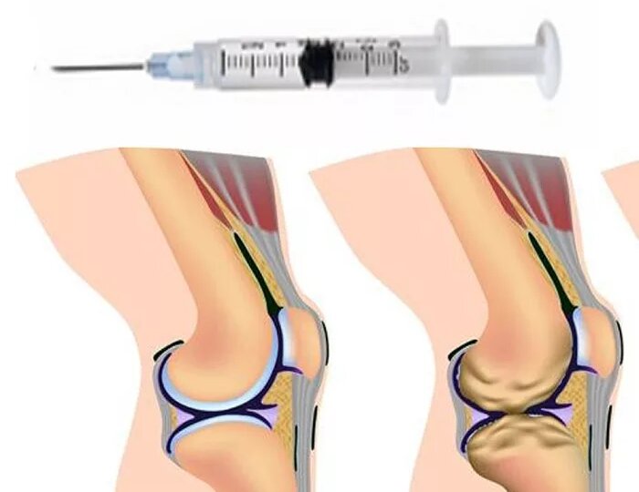 Уколы гиалуронки в суставы: чудо или просто временное облегчение?