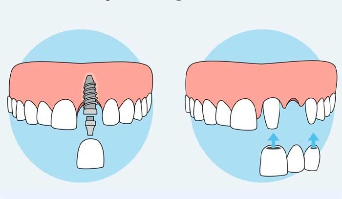 Зубные мосты и зубные имплантаты