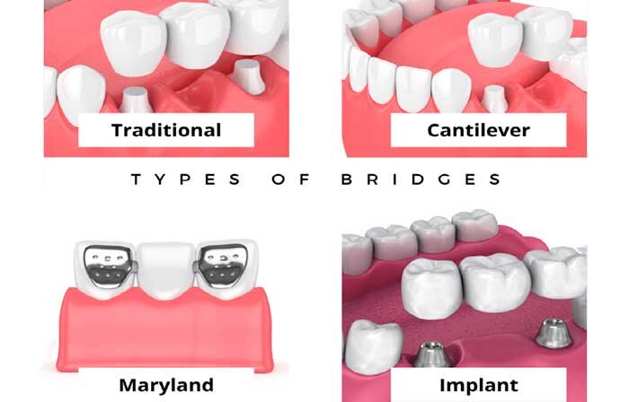 Типы зубных мостов