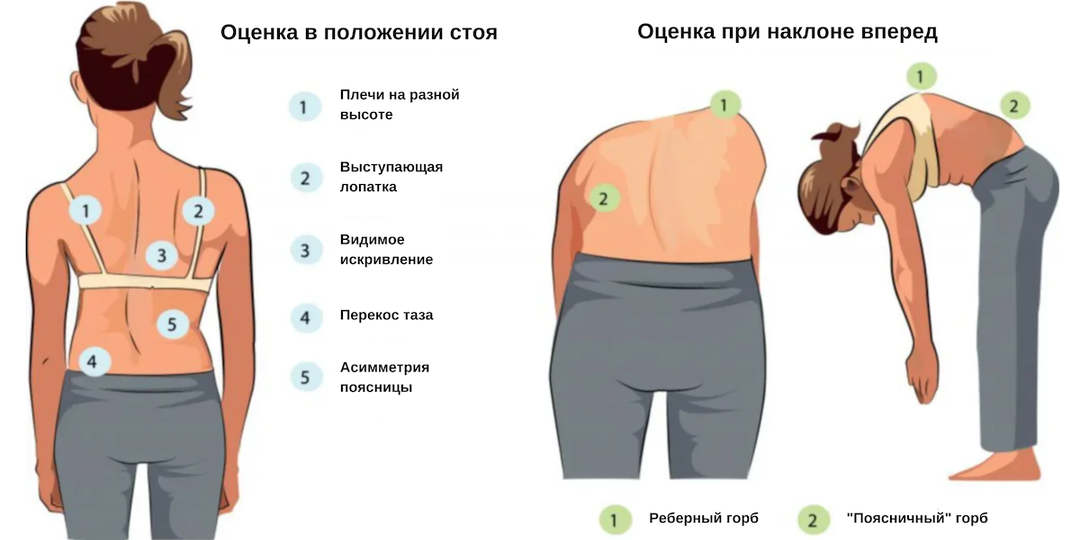 Роль дыхания в методе 3D коррекции сколиоза Катарины Шрот
