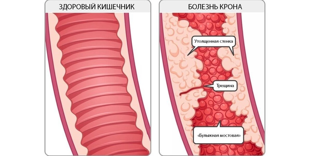 Болезнь Крона: Симптомы и Признаки — как распознать воспалительное заболевание кишечника