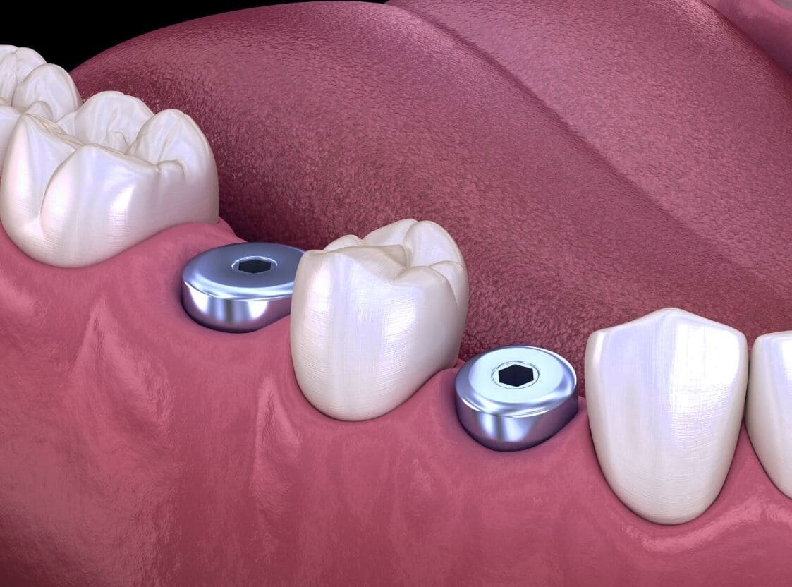 Импланты зубов