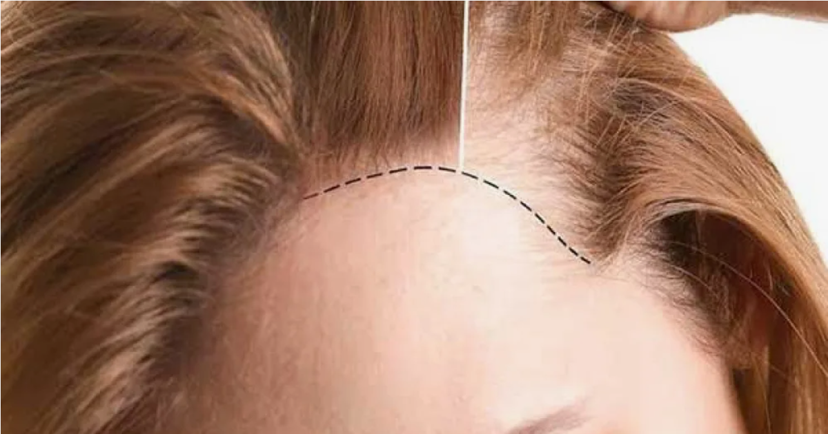 Залысины на лбу у женщин: как их убрать с помощью пересадки волос