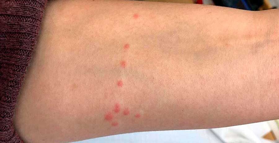 укусы на руке