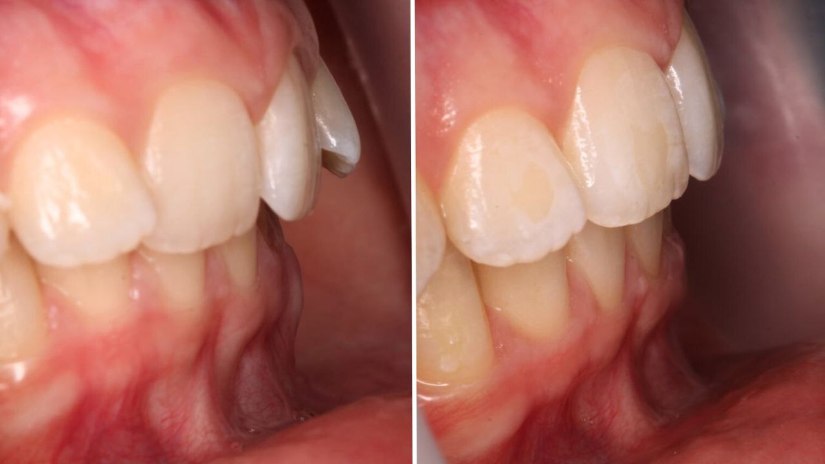 До/после ортодонтического лечения.