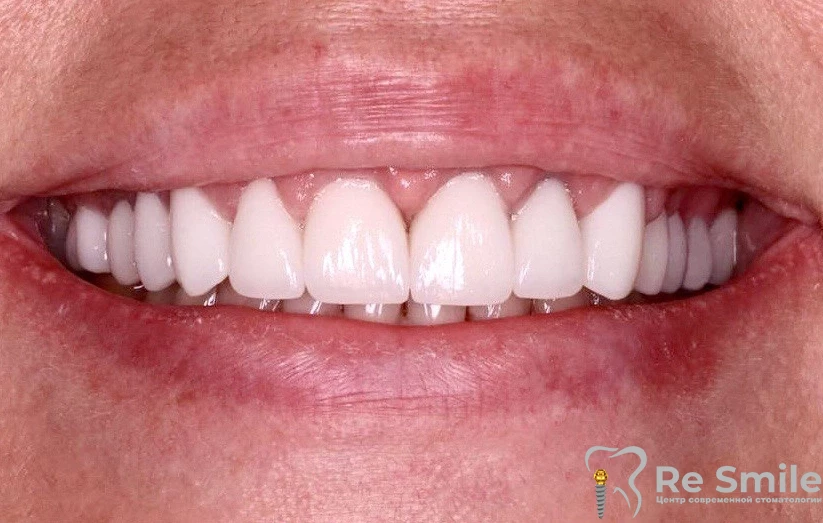 Пациентка обратилась с жалобами на эстетический дефект зубного ряда верхней челюсти.

Были установлены керамические виниры E-max во фронтальной области и коронки E-max на жевательные зубы.