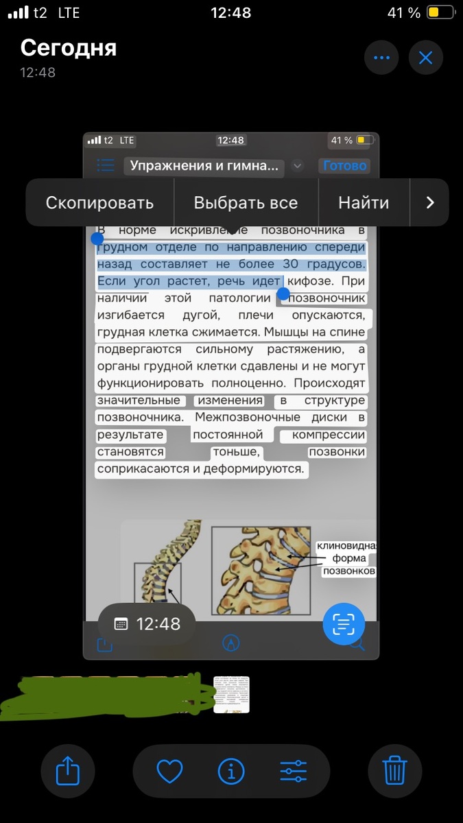 Вот вам тут о кифозе почитать)