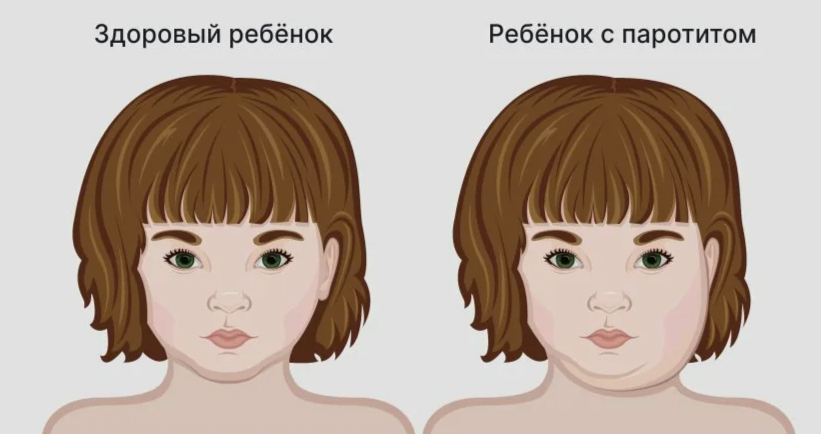 рисунок с сайта gemotest.ru/info/spravochnik/zabolevaniya/epidemicheskiy-parotit-svinka/