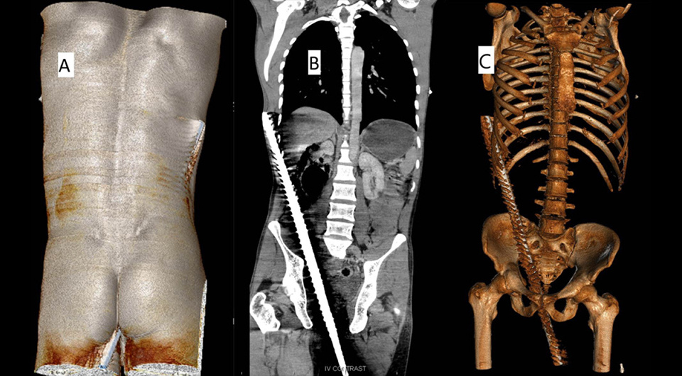   Nandakumar B M et al. / BMJ Case Reports, 2025