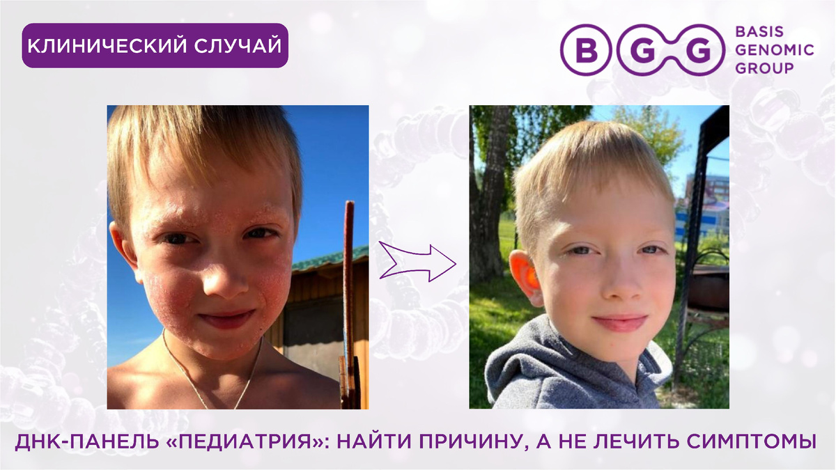 Статья от Basis Genomic Group «Персонализированная медицина в действии: как ДНК-тест помог выявить триггер кожного заболевания у ребенка. Разбор кейса»