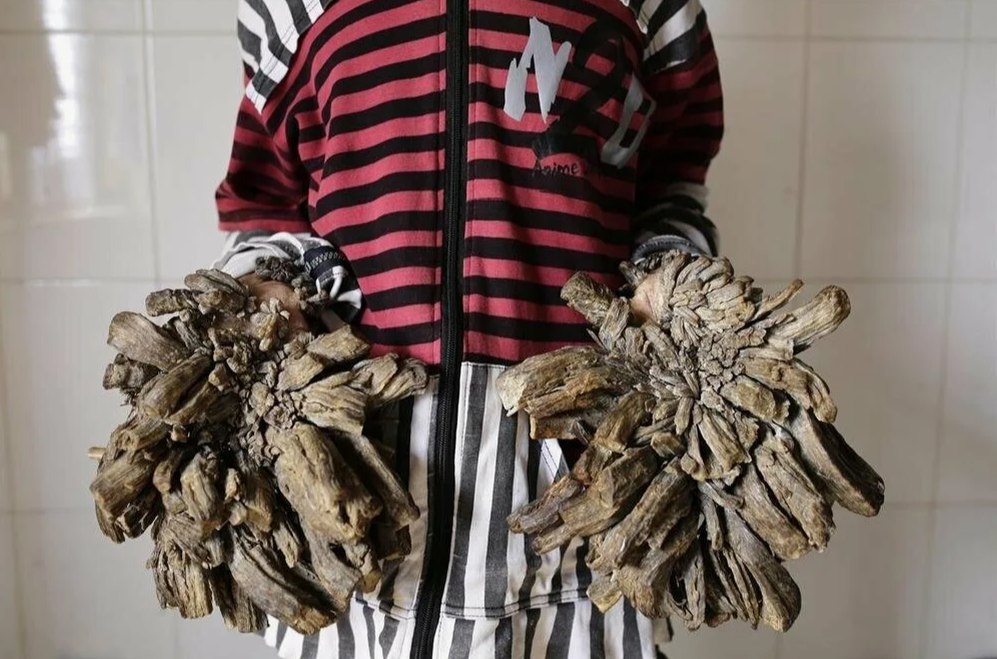 Бородавчатая эпидермодисплазия Левандовского-Лютца. Изображение взято из Интернета.