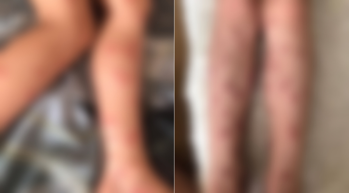 Так выглядят недуги в результате заболевая. Заблюрили фото, чтобы не шокировать читателей. Версия без купюр в нашем Телеграме