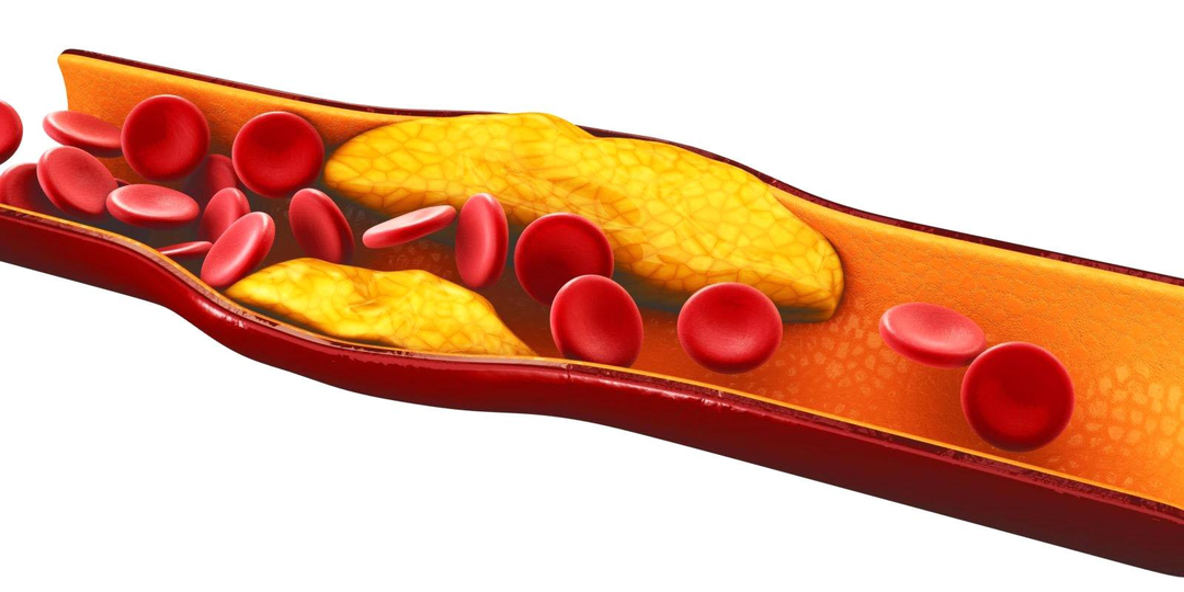 Почему врачи так переживают за ваш высокий холестерин: как его снизить, диагностировать и лечить