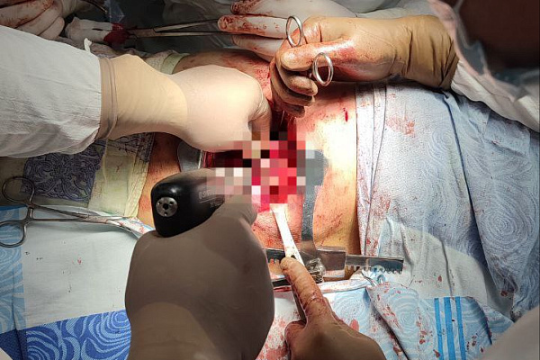    Хирурги Сургута сумели извлечь лёгкое из межрёберного пространства пациента после травмы