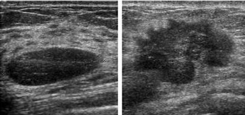 Слева доброкачественная опухоль, а справа - рак молочной железы