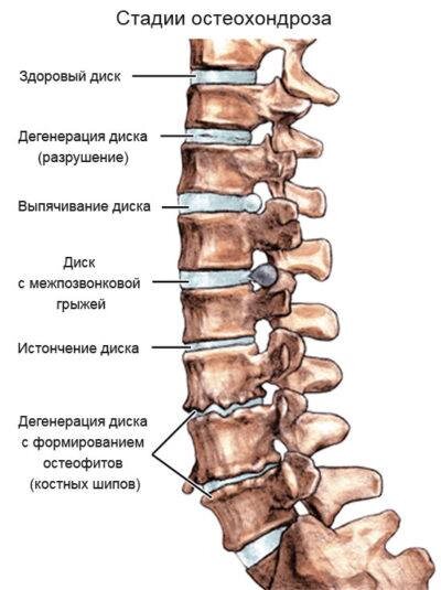 Что такое «остеохондроз