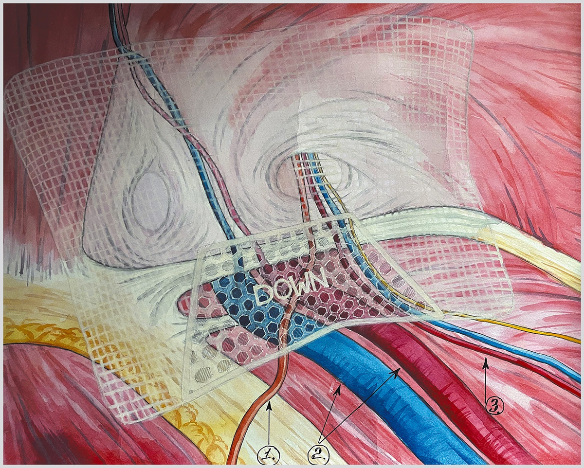 Рис. 1. Сетчатый эндопротез Реперен-10-2, размещенный в правой паховой области.
1 — семенной канатик; 2 — подвздошные артерия и вена; 3 — гонадные сосуды.