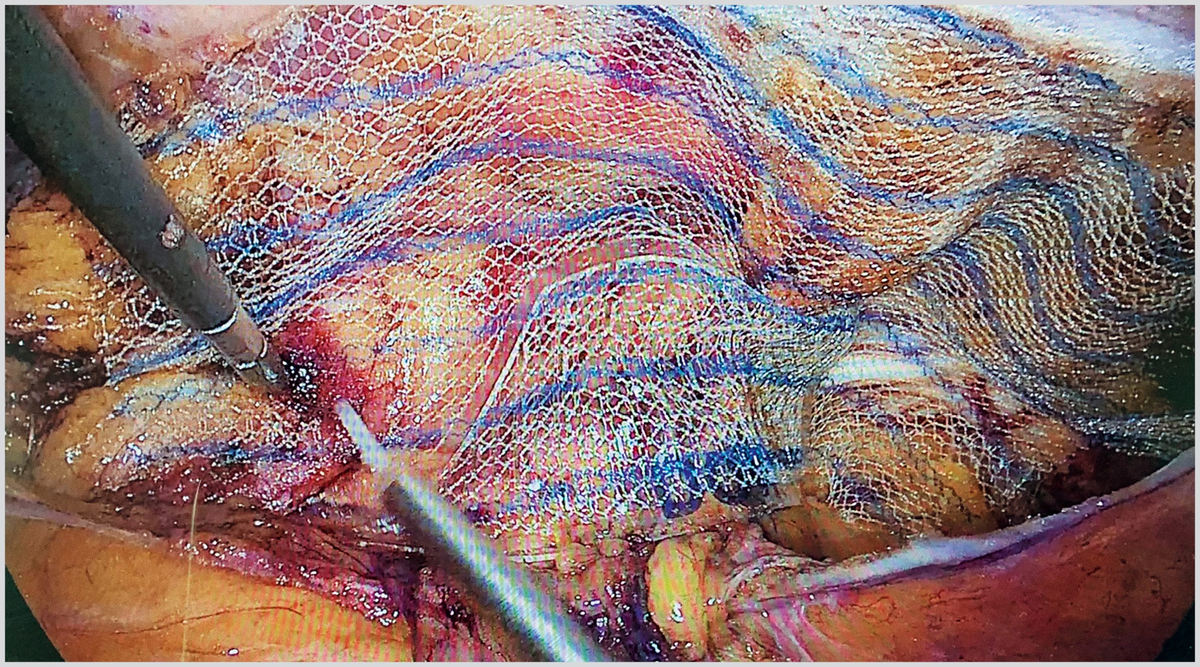 Рис. 2. Фиксация сетчатого эндопротеза Реперен-10-2 биологическим клеем Glubran-2 (интраоперационное фото).