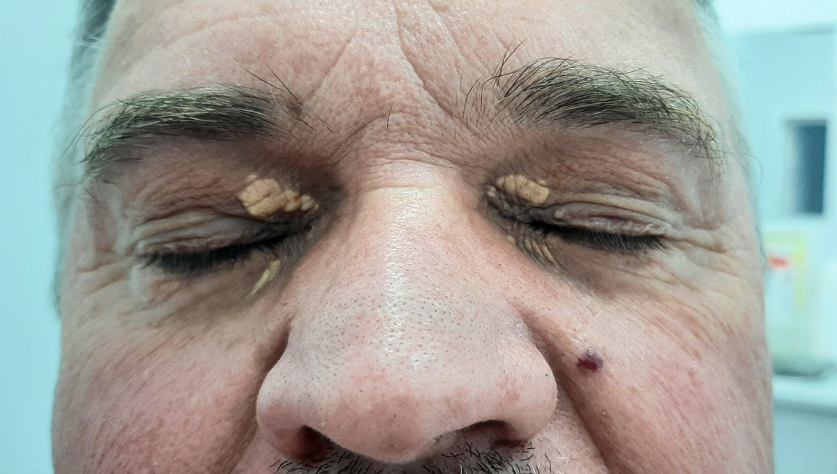 На фото состояние непосредственно перед операцией. Отчётливо видны ксантелазмы верхних и нижних век, папиллома верхнего века слева и гемангиома кожи левой щеки.