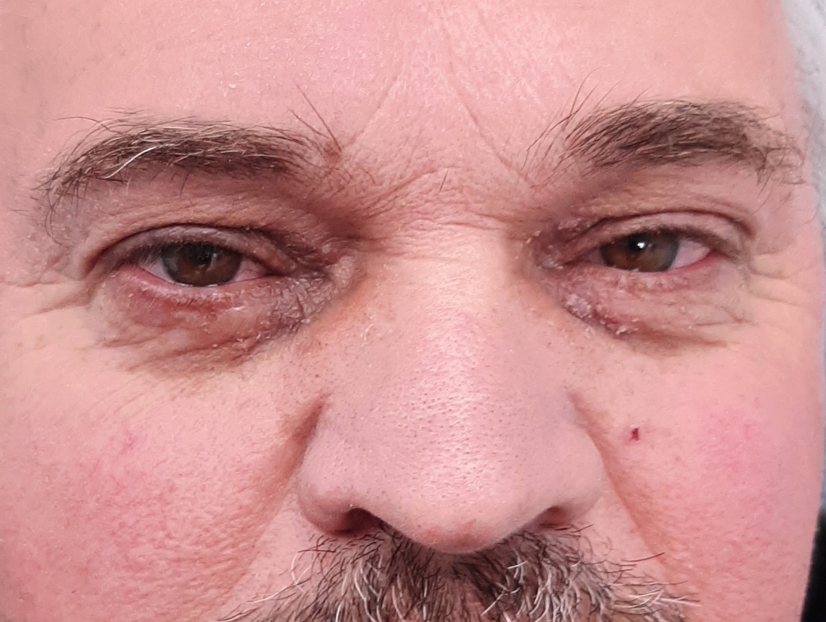 Через 2 недели после операции. Только что удалены лигатуры. Отечности век и кровоподтёков уже практически нет. Видны остатки корочек в послеоперационных областях. Под ними происходит окончательное восстановление эпидермиса (поверхностного слоя кожи). На щеке слева хорошо заметна остаточная корочка после радиочастотного удаления гемангиомы.