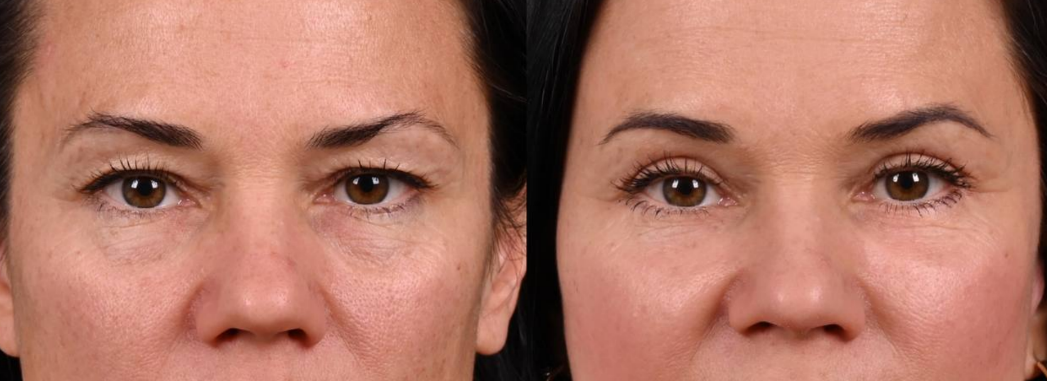 Пластика верхних век и липофилинг нижних век. Фото до и после. Фото с сайта хирурга Д.Р. Гришкяна. Имеются противопоказания, требуется консультация специалиста