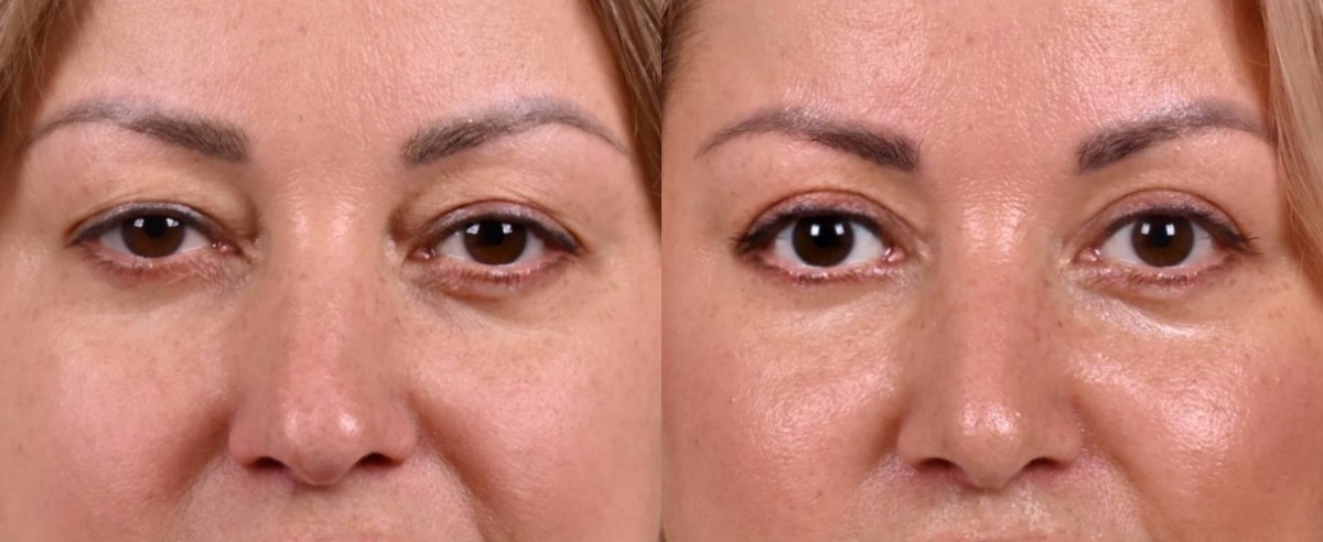 Блефаропластика верхних век фото до и после. Фото с сайта хирурга Д.Р. Гришкяна. Имеются противопоказания, требуется консультация специалиста