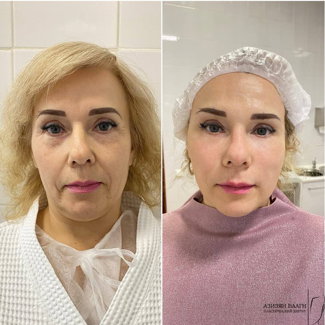 Выполнен эндоскопический лифтинг средней зоны лица, лба и бровей.