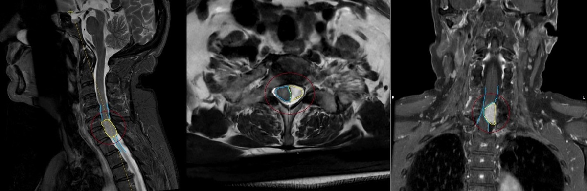 МРТ-исследование шейного отдела позвоночника и спинного мозга с контрастным усилением (до оперативного вмешательства). На уровне С6-С7 позвонков, преимущественно слева, визуализирована опухоль – менингиома (контур выделен жёлтым цветом). Менингиома вызывает грубую компрессию и смещение спинного мозга на данном уровне (максимально до 70-80% позвоночного канала, контур спинного мозга обозначен голубым цветом).