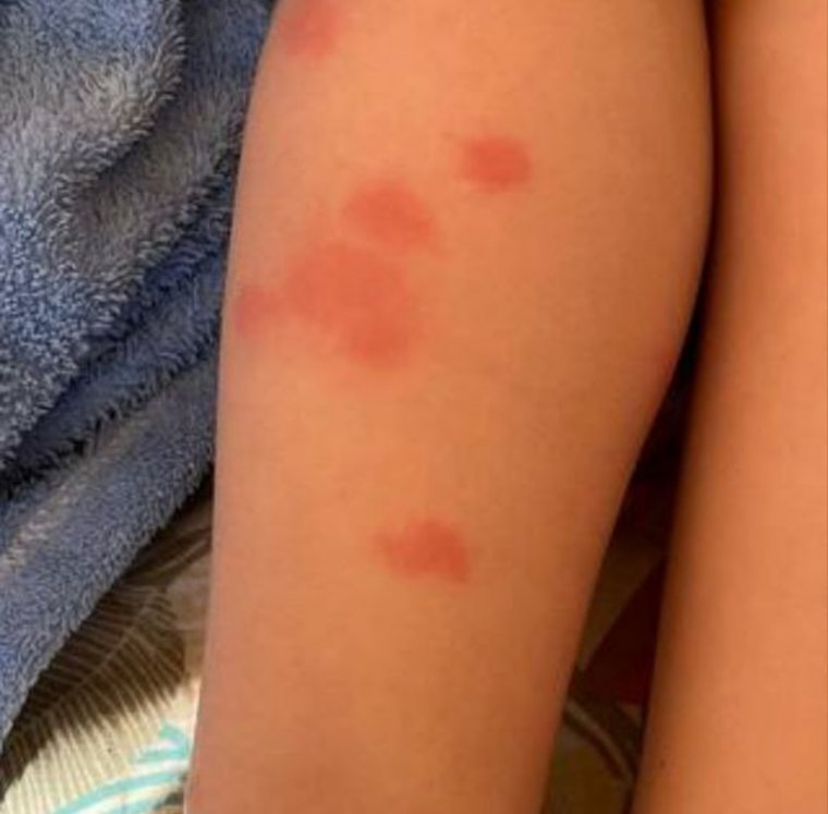 По словам родителей, воспитанники д/с №62 каждый день возвращаются из сада с укусами комаров и мошек. Фото: Читатель URA.RU