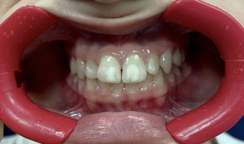 Гипоплазия эмали