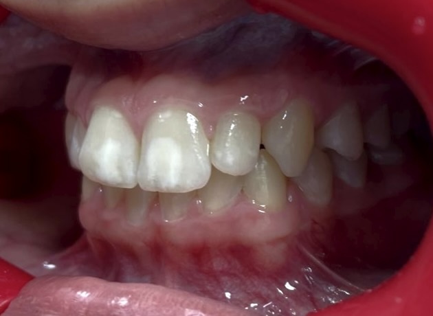 Пятнистая форма системной гипоплазии