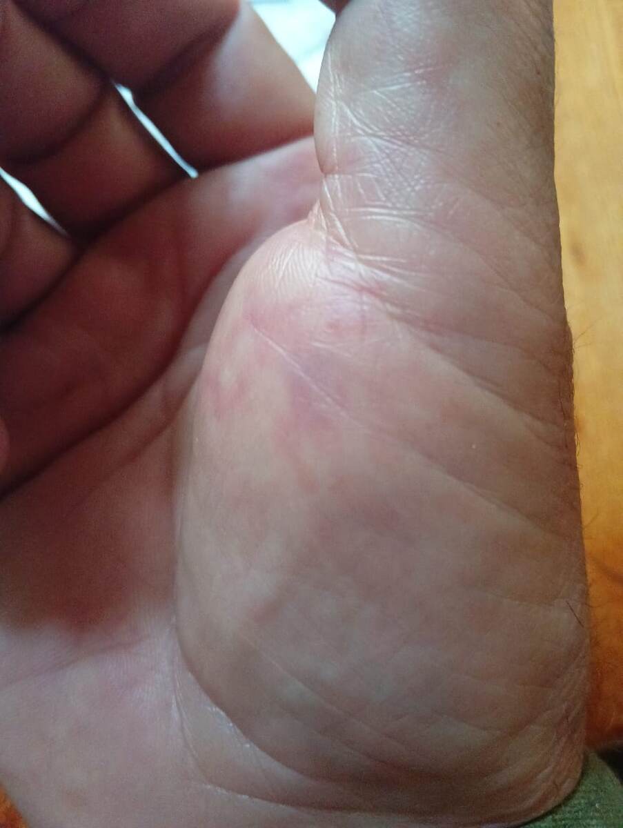 Распухшая рука через сутки.