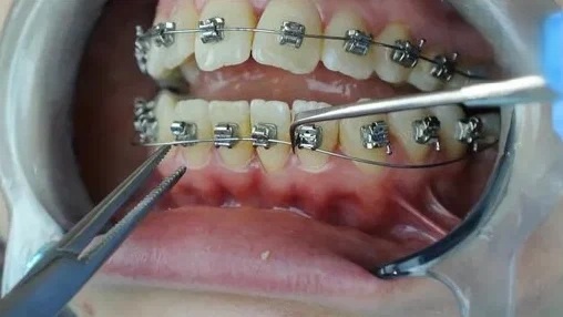 Процесс снятия силовой дуги с замков