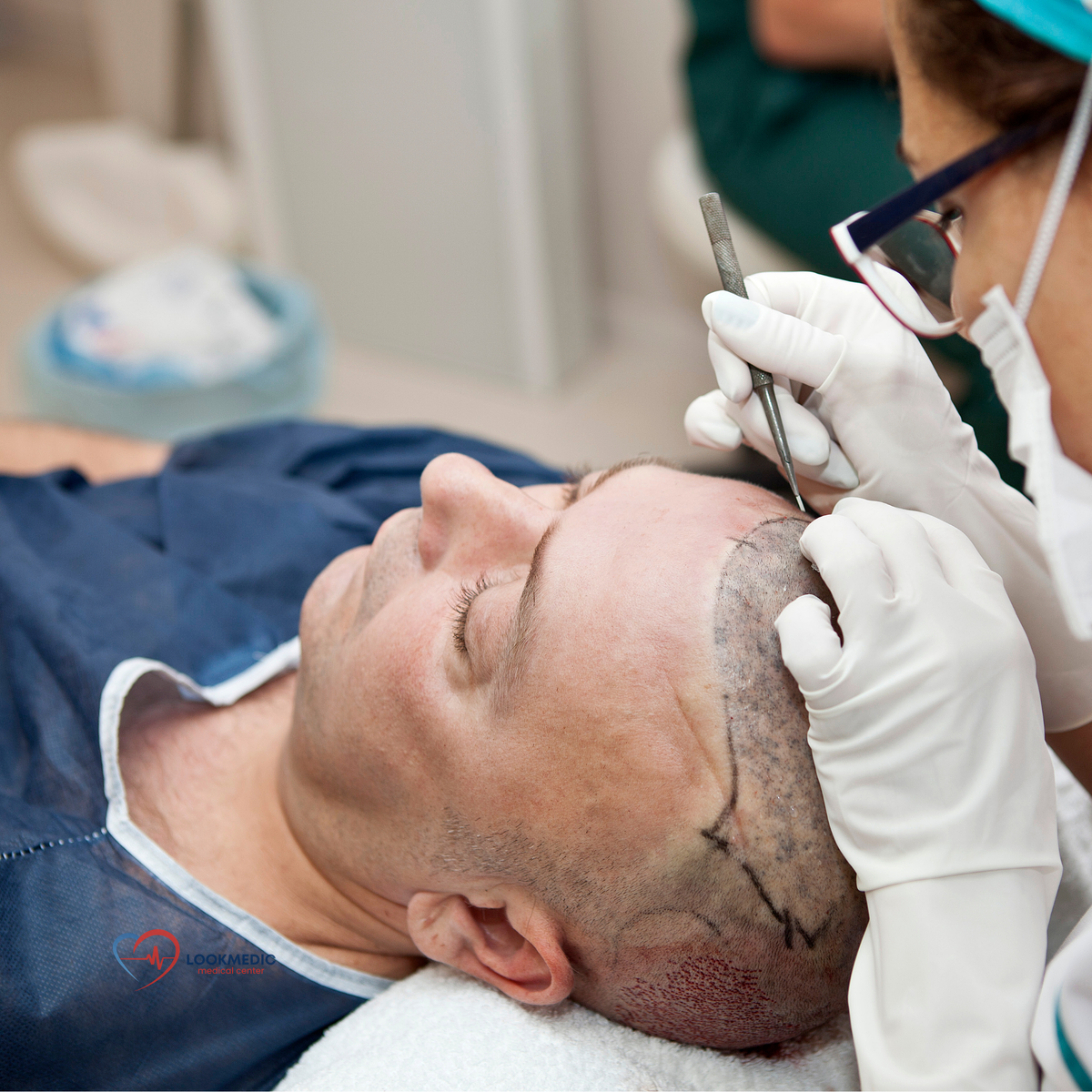 Пересадка волос