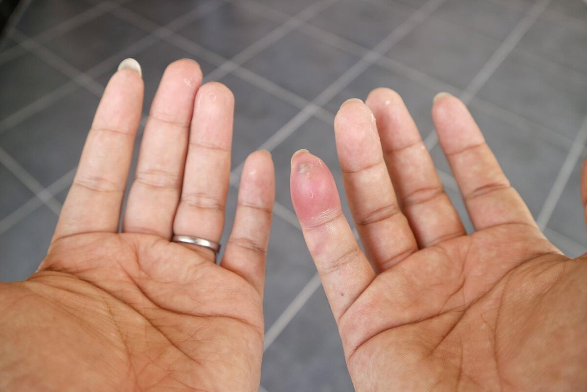 Galih Surya Alam / Shutterstock / FOTODOM📷Иногда укус бывает практически незаметным, особенно если паук маленький или его яд слишком слаб для человека