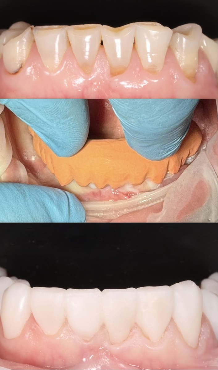 Mock-Up в стоматологии