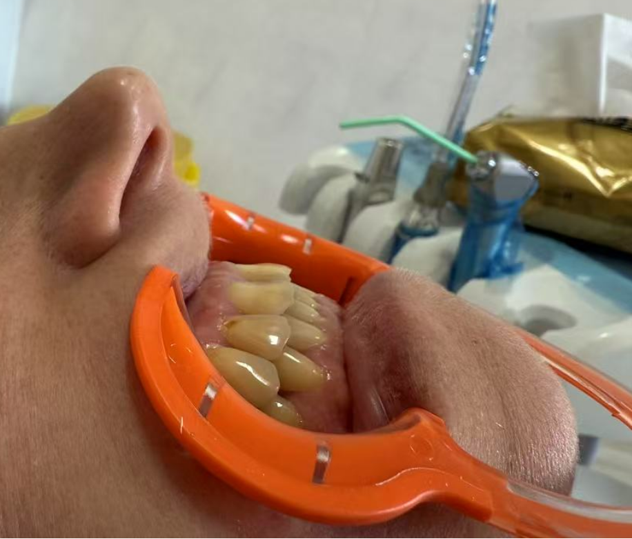 До протезирования, вид сбоку.