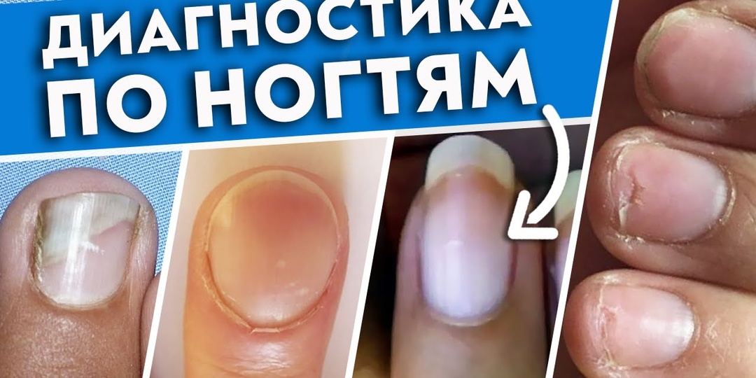 Что значит, если Начали темнеть НОГТИ