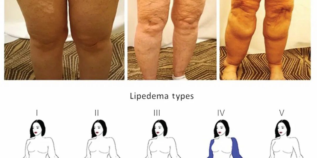А вы уверены, что у вас ожирение? Это может быть липедема…