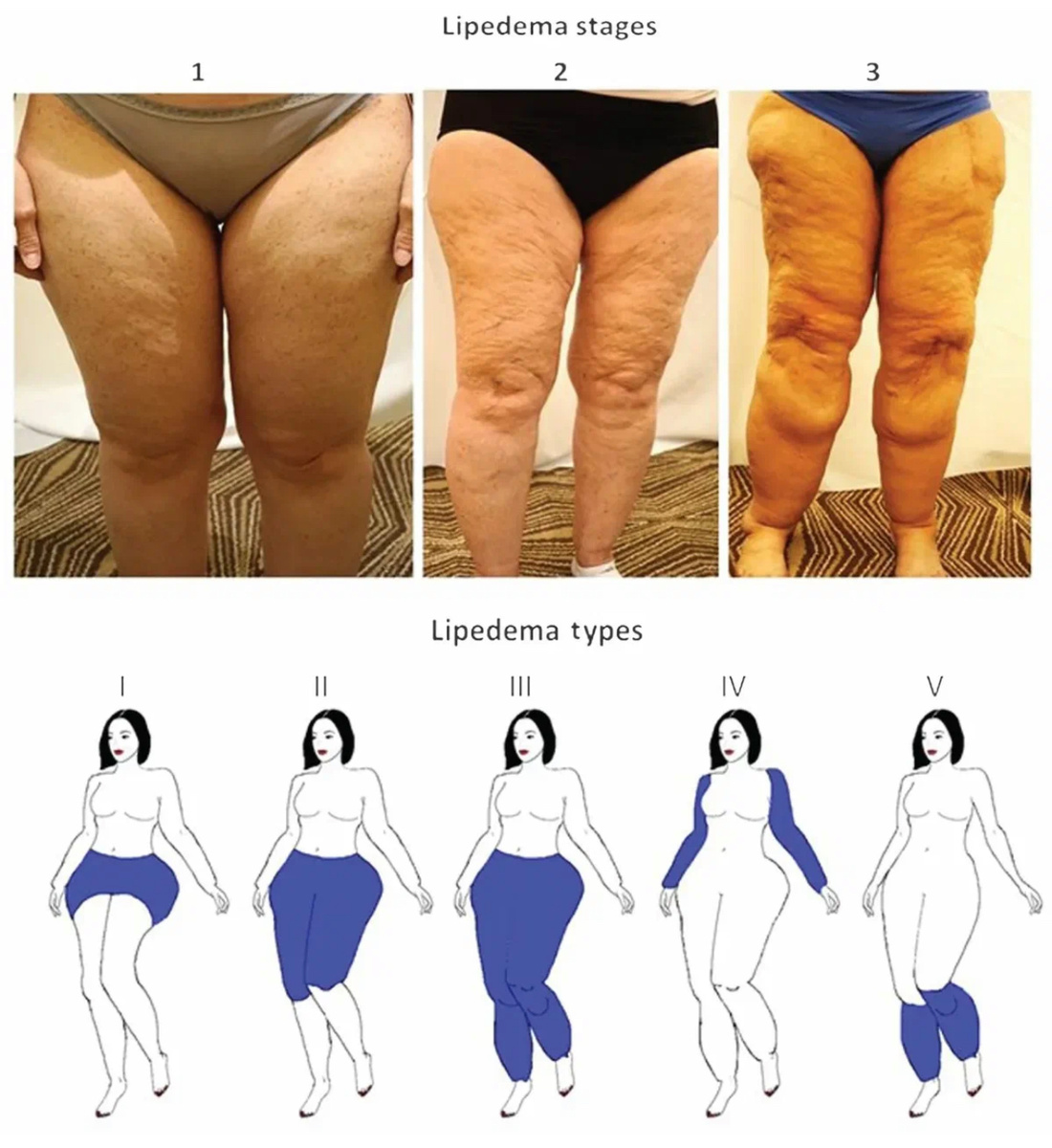 Зоны, которые поражает липедема