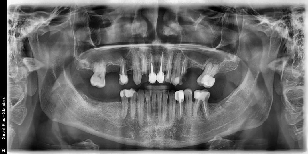 Почему нельзя ехать в Китай на протезирование зубов без панорамного снимка: важное предостережение для всех, кто планирует лечение в Хэйхэ