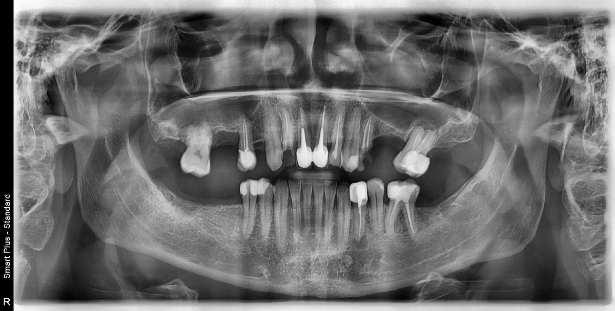 Пример панорамного рентген - снимка (снимок ОПТГ).