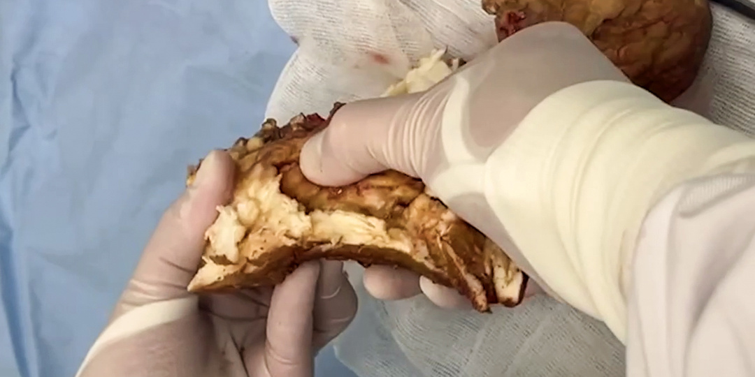 Врачи Склифа извлекли из желудка женщины окаменелый комок из хлебцов