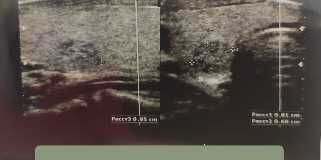 Что должно обязательно быть в описании УЗИ щитовидной железы