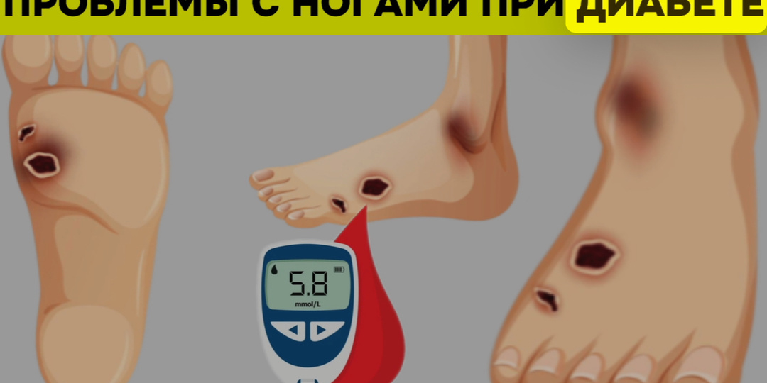 Семь тревожных звоночков для диабетиков: как уберечь ноги от опасности