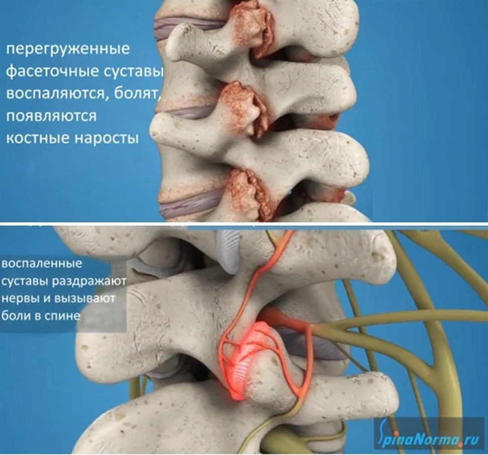 Причина боли - страдание позвоночного нерва