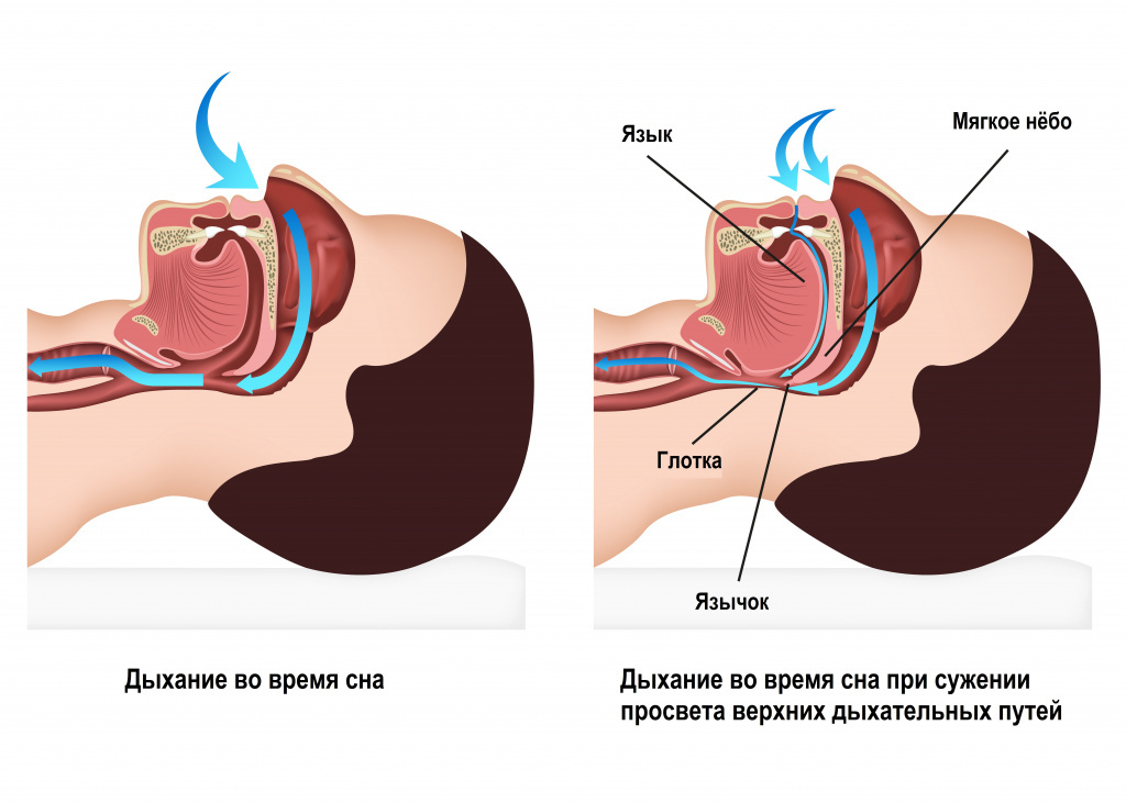 Почему люди храпят?