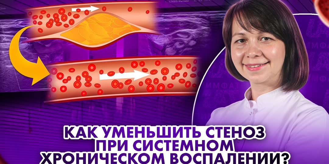 Атеросклероз и аутоиммунные болезни: как уменьшить стеноз при системном хроническом воспалении