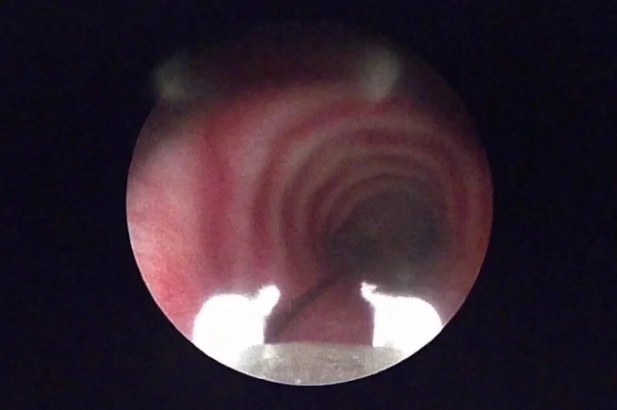    В Приморье врачи спасли школьника, проглотившего булавку